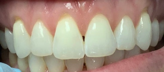 Connective Tissue Graft Before