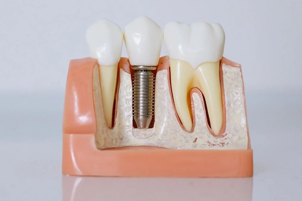 Dental Implants