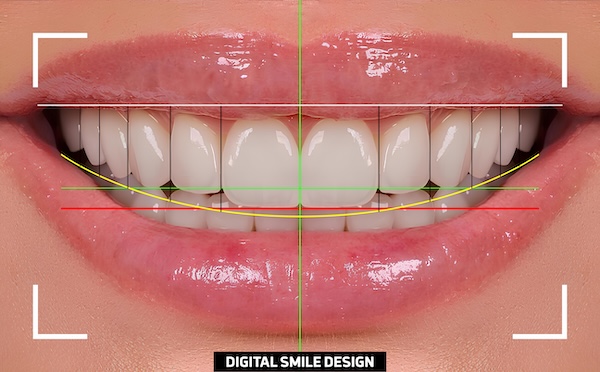 Digital Smile Design