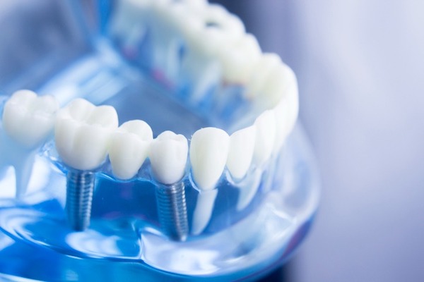 Dental Implants 2