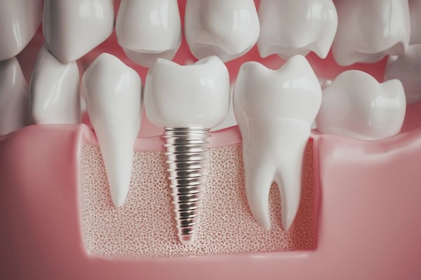 Dental Implants 3