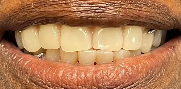 Partial dentures after 2