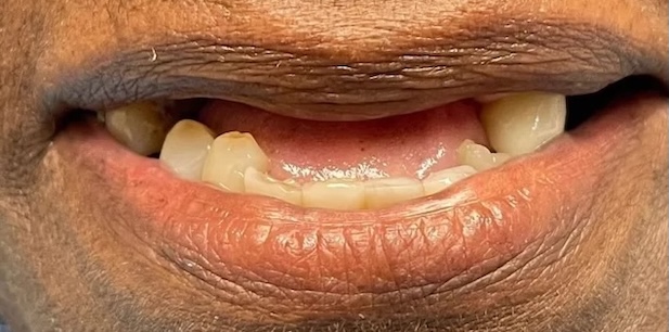 Partial dentures before 2