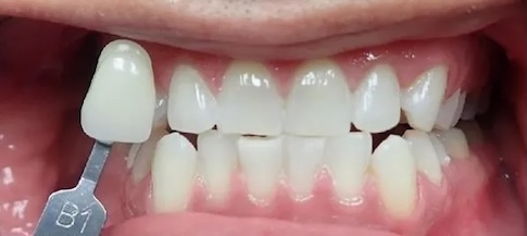 Whitening after