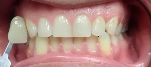 Whitening before